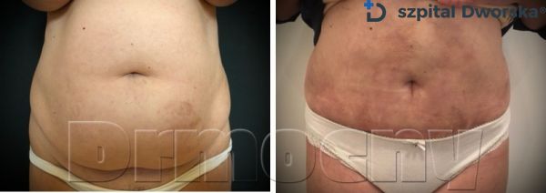 Liposukcja Vaser Lipo i miniplastyka brzucha