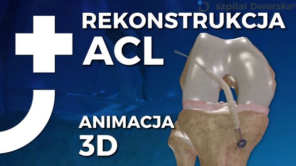 Rekonstrukcja ACL kolana animacja
