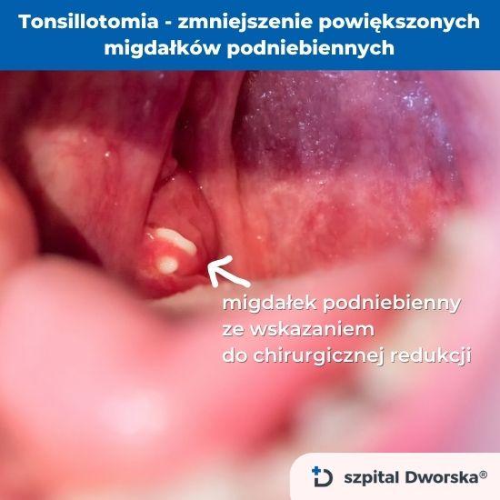 tonsillotomia zmniejszenie migdałków podniebiennych