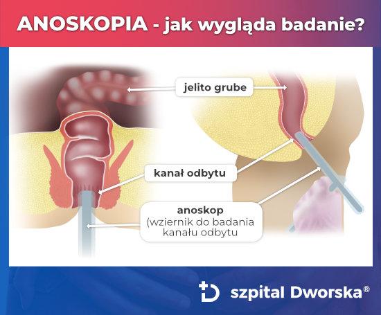 Anoskopia - badanie odbytu wziernikiem