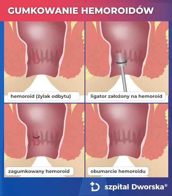 Gumkowanie hemoroidów - metoda leczenia żylaków odbytu