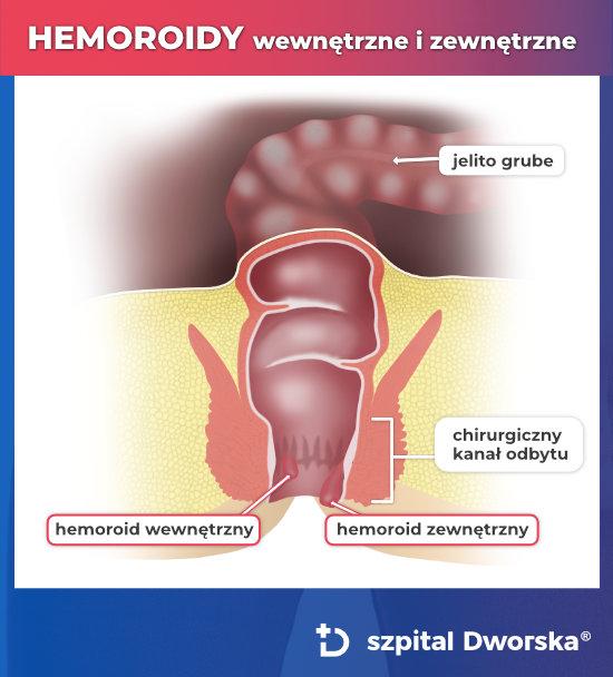  Hemoroidy wewnętrzne a zewnętrzne