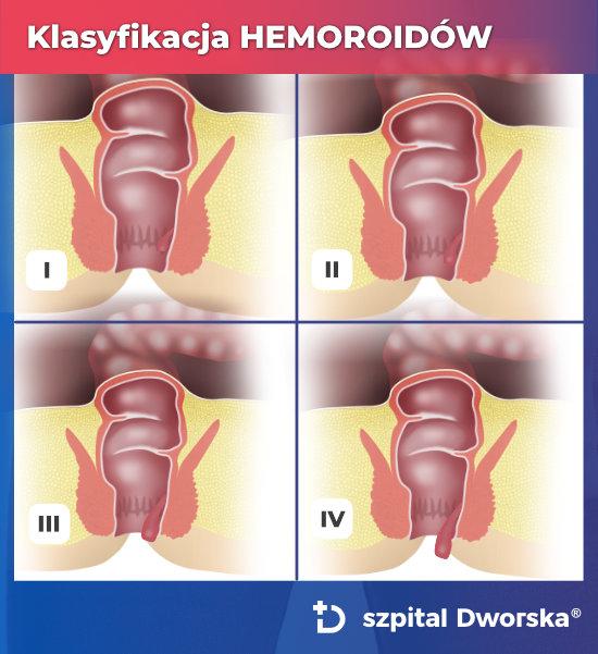 Klasyfikacja hemoroidów na podstawie badania proktologicznego